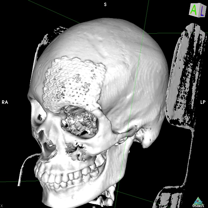 Пластика основания черепа: полное руководство по современным методам лечения