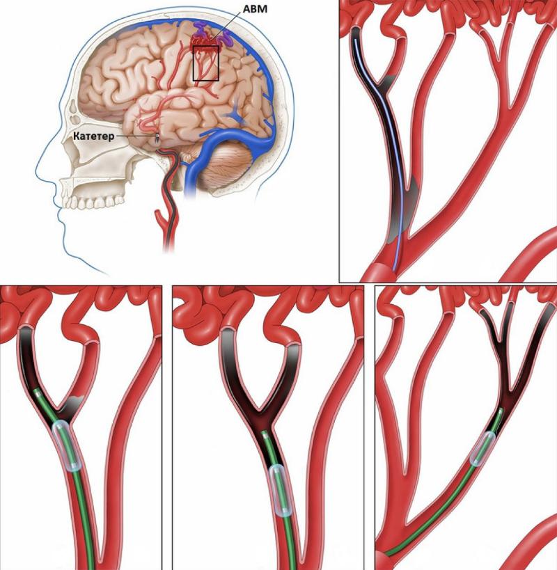 Реваскуляризация головного мозга для восстановления кровотока и защиты от инсульта