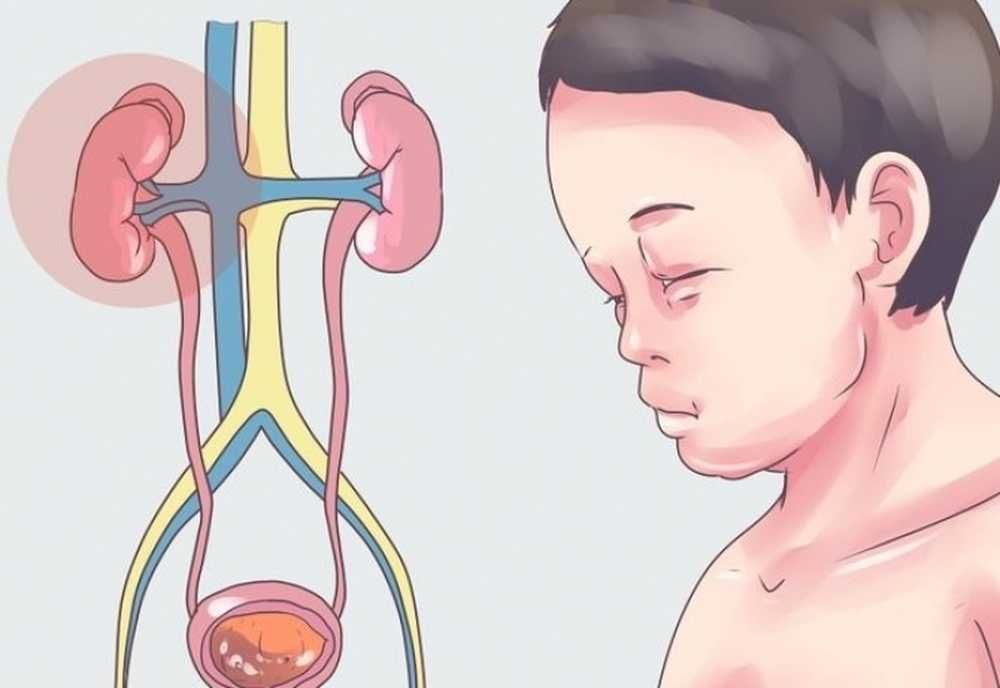 Нефротический синдром: как вернуть здоровье почкам и избавиться от отеков