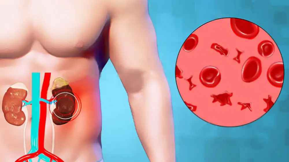 Гемолитико-уремический синдром: полное руководство по причинам и лечению