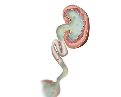 Рефлюкс-нефропатия: полное руководство по защите почек от повреждения