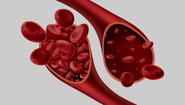 Анемия при хронической болезни почек: как вернуть силы и улучшить самочувствие