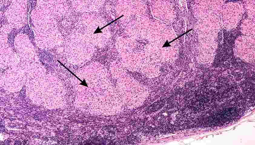 Саркоидоз почек: как сохранить здоровье и функцию жизненно важного органа