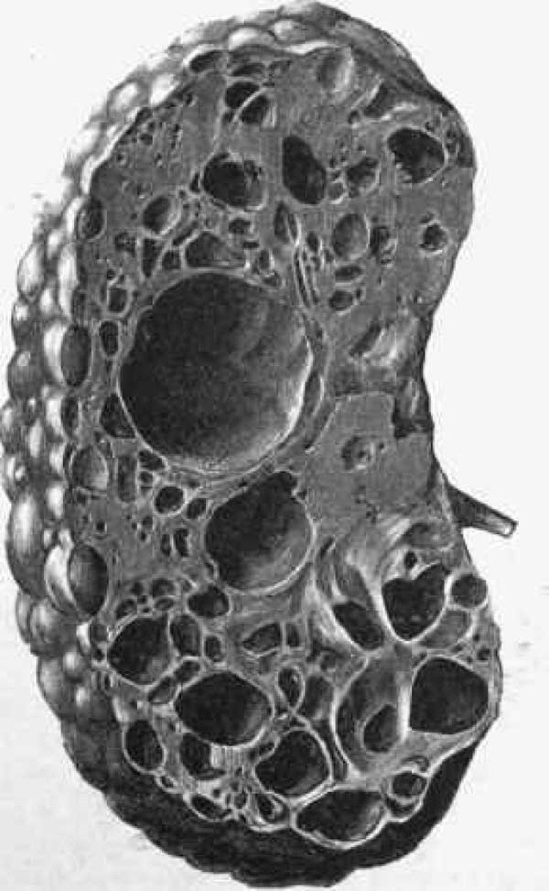 Губчатая почка: полное руководство по диагностике, лечению и жизни с диагнозом
