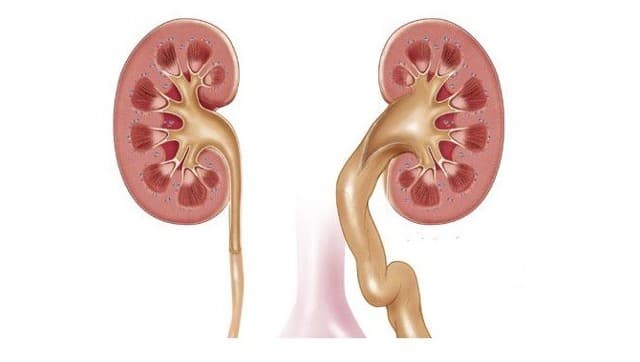 Гидронефроз почки: полное руководство по причинам, симптомам и лечению