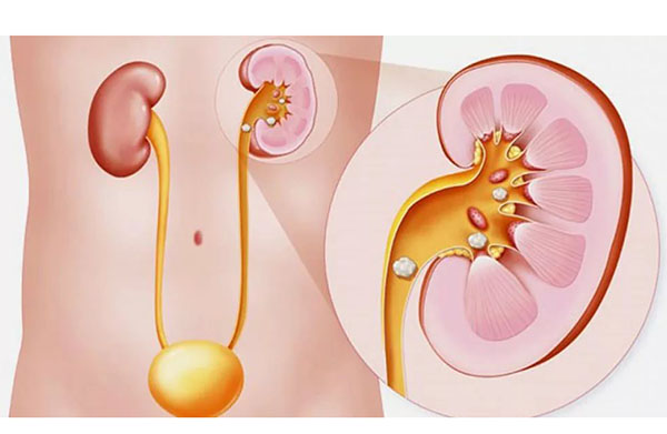 Уратная нефропатия: как защитить почки от избытка мочевой кислоты