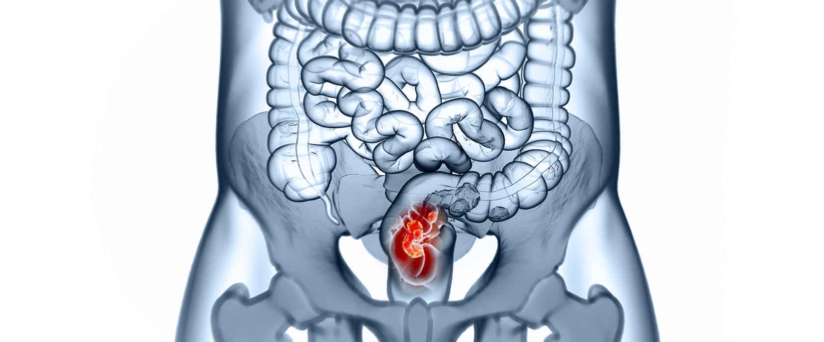 Рак прямой кишки: полное руководство от симптомов до лечения и прогноза