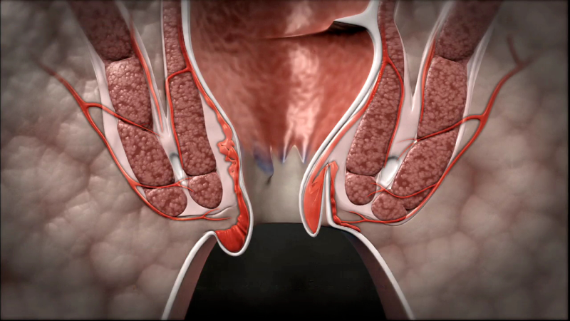 Рак анального канала: полное руководство по диагностике, лечению и прогнозу