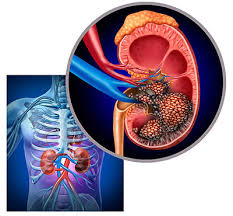 Рак почки: полное руководство по диагностике, лечению и прогнозу