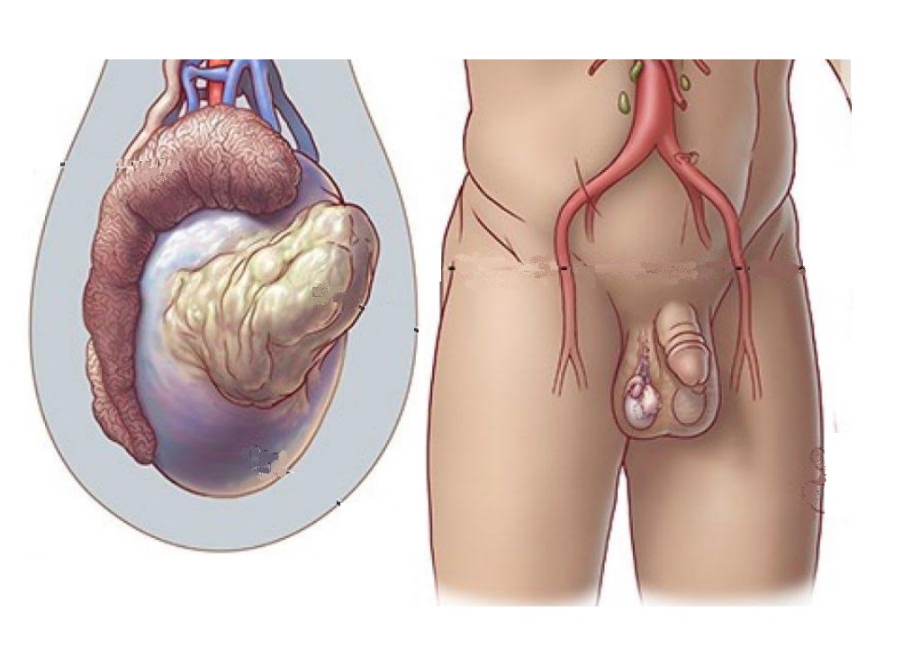 Рак яичка: полное руководство по симптомам, диагностике и лечению онкологии
