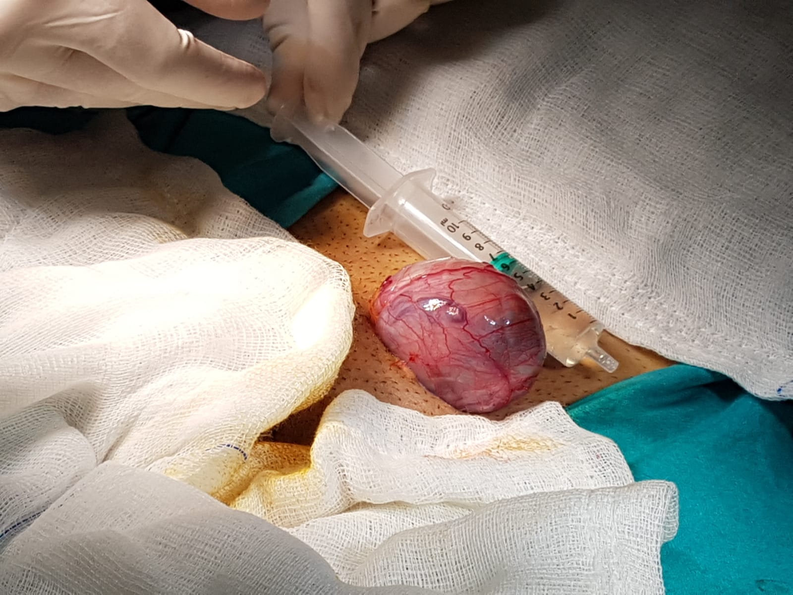 Рак полового члена: полное руководство по диагностике, лечению и прогнозам