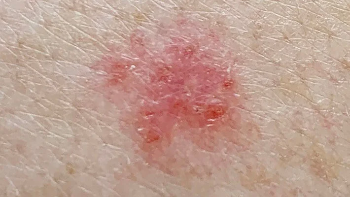 Базалиома кожи: полное руководство по диагностике, лечению и профилактике