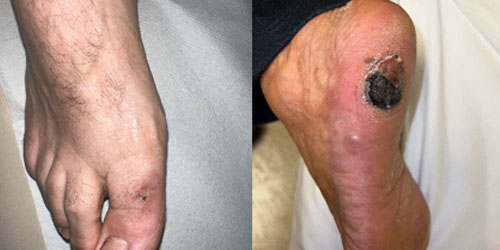 Саркома Капоши: полное руководство по диагностике, лечению и прогнозу