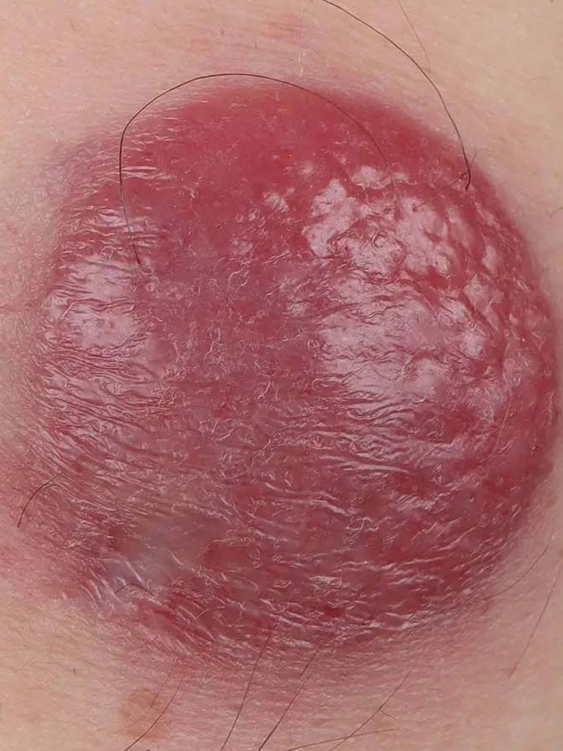 Рак из клеток Меркеля: полное руководство по диагностике и лечению