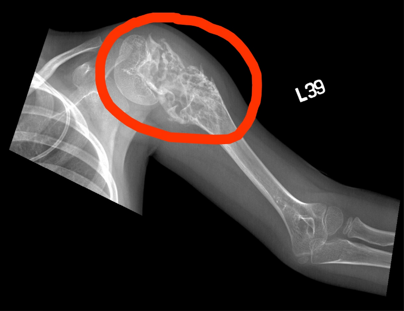 Саркома Юинга: полное руководство по диагностике, лечению и прогнозу