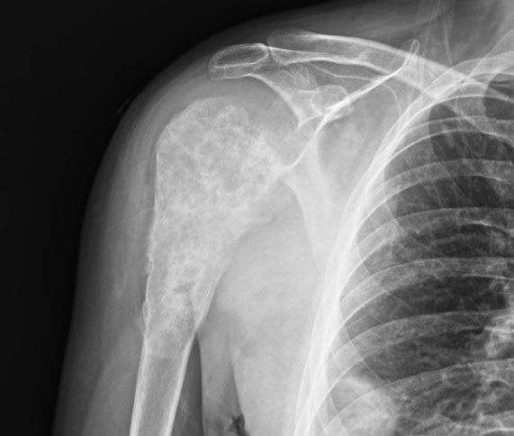 Хондросаркома: полное руководство по видам, лечению и прогнозу выживания