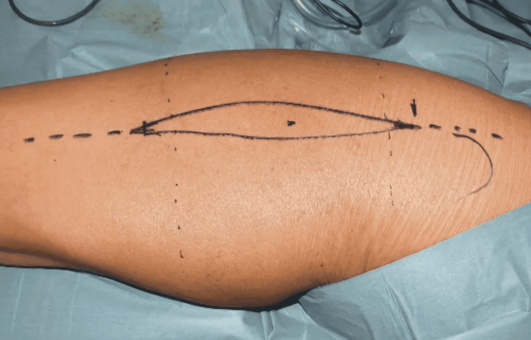 Саркома мягких тканей: полное руководство по диагностике и лечению