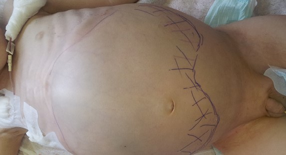 Нейробластома у детей: полное руководство для родителей по лечению и прогнозу