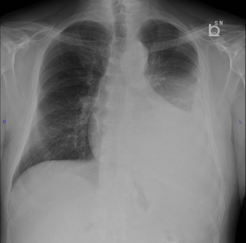 Мезотелиома плевры: ваш полный гид по диагностике, лечению и прогнозу