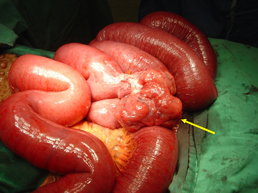Гастроинтестинальная стромальная опухоль (ГИСО) как диагноз и путь к лечению