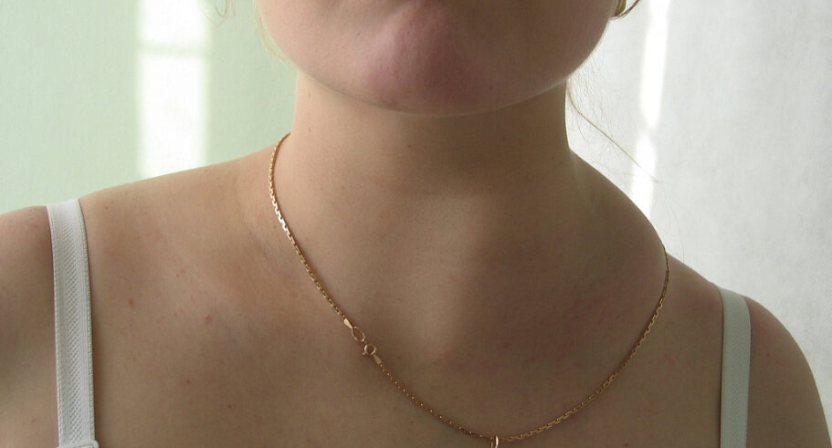 Лимфома Ходжкина: полное руководство по диагностике, лечению и прогнозу