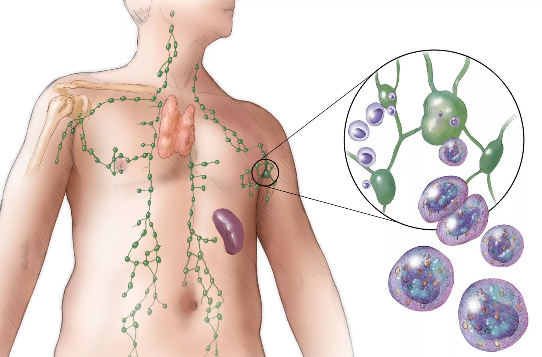 Неходжкинская лимфома: ваш полный путеводитель по диагностике и лечению