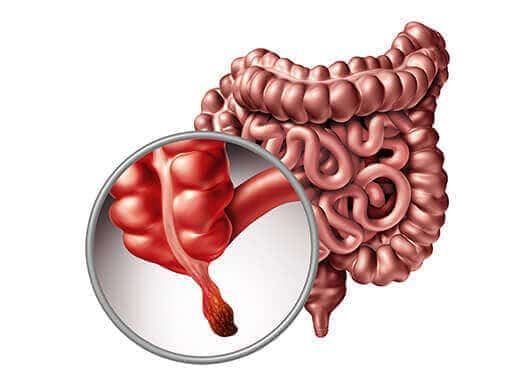 Рак аппендикса: полное руководство по диагностике, лечению и прогнозу