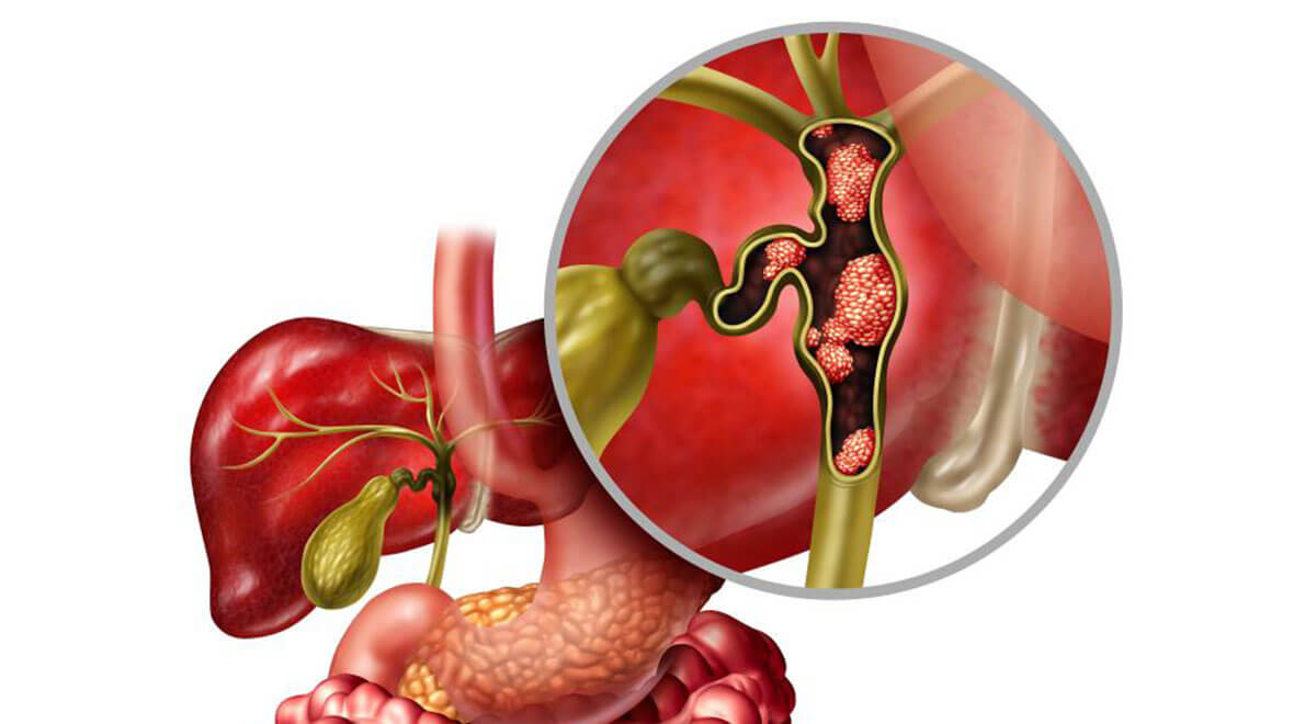 Холангиокарцинома: обрести ясность и выбрать правильный путь лечения рака