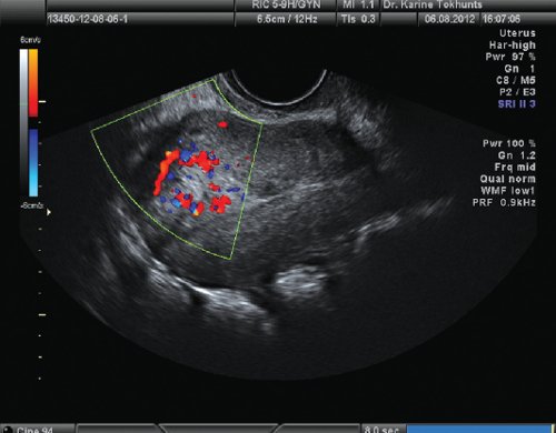 Обрести уверенность в лечении трофобластической опухоли: полное руководство