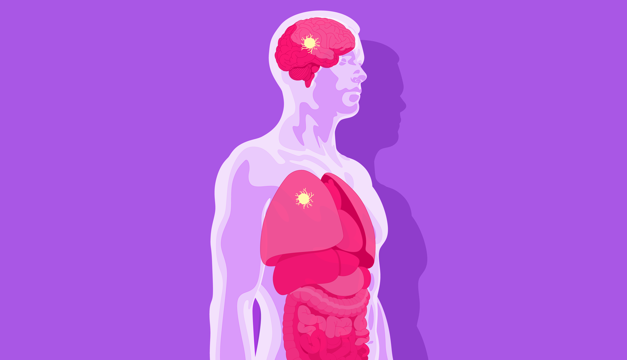 Рак из невыявленного первичного очага: полный гид по диагнозу и лечению