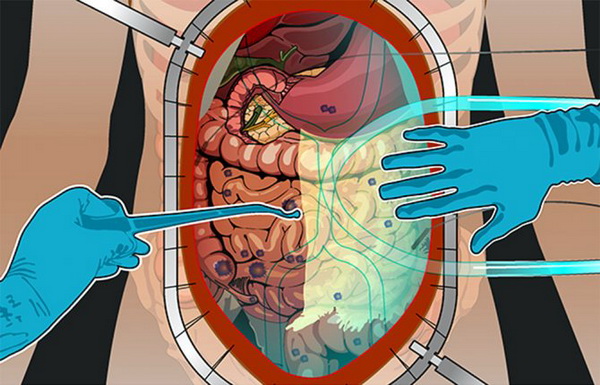 Канцероматоз брюшины: современные методы лечения для улучшения прогноза