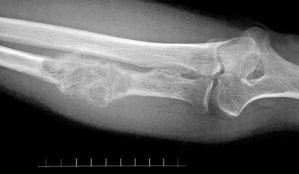 Метастазы в кости: полный гид по диагностике, лечению и прогнозу
