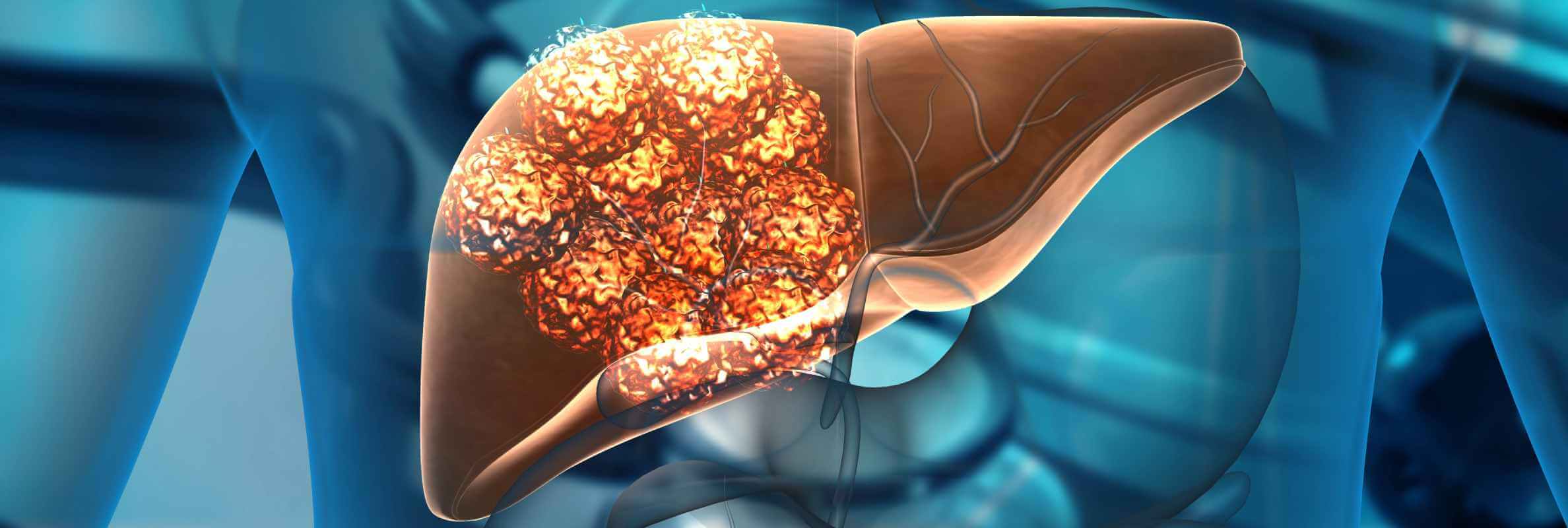 Современные подходы к лечению метастазов в печени для продления жизни