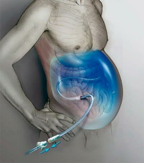 Асцит при онкологии: обретение контроля над симптомом и улучшение жизни