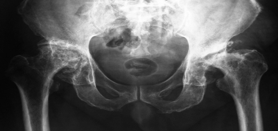 Асептический некроз головки бедра: как сохранить сустав и вернуться к жизни