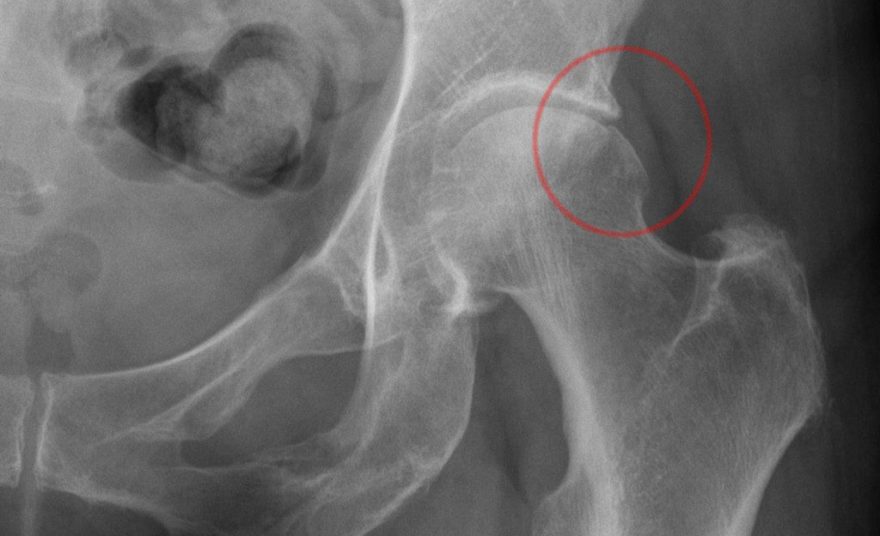 Феморо-ацетабулярный импинджмент: вернуть суставу здоровье и подвижность