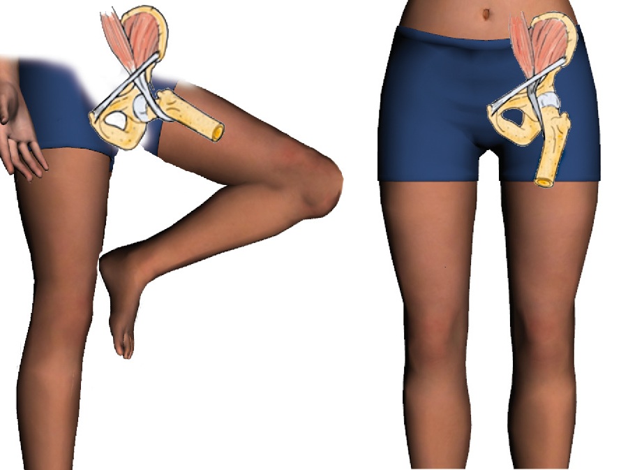 Синдром щелкающего бедра: обрести свободу движения без боли и щелчков