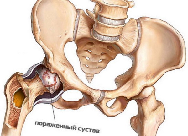 Болезнь Легга-Кальве-Пертеса: путь к восстановлению сустава и жизни без боли