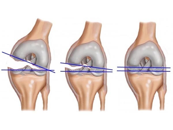 Восстановить подвижность колена при разрыве мениска: от симптомов до лечения