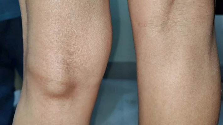 Киста Бейкера коленного сустава: полное руководство по лечению и диагностике