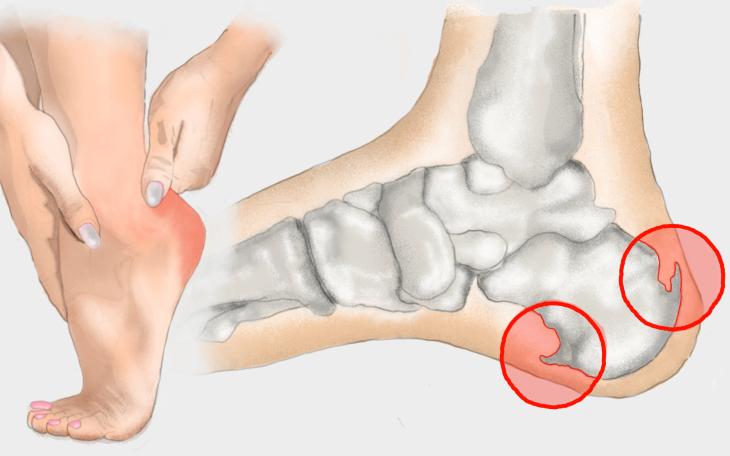 Полное руководство по лечению пяточной шпоры: вернуть легкость походке