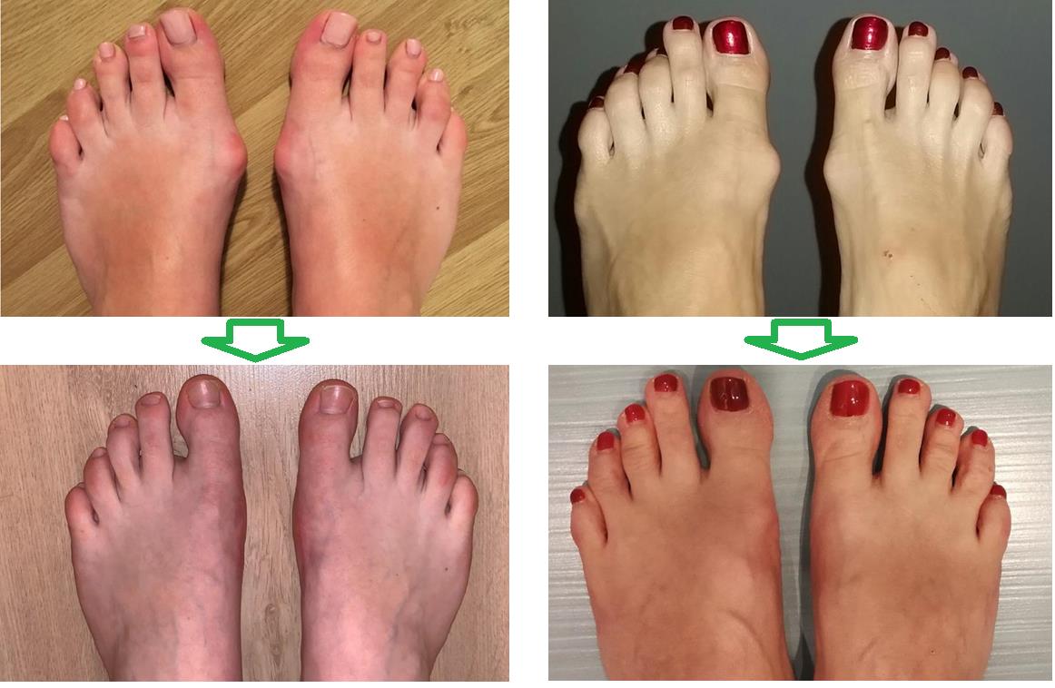 Халюс вальгус (Hallux valgus): вернуть легкость походке и избавиться от боли в стопе