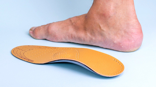 Плоскостопие у взрослых: полное руководство по диагностике и лечению