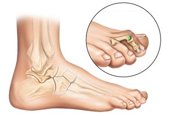 Молоткообразная деформация пальцев стопы: полное руководство по лечению