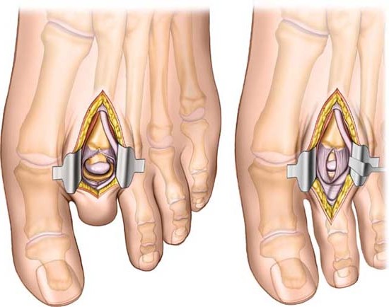 Неврома Мортона: обрести легкость в каждом шаге без боли между пальцами