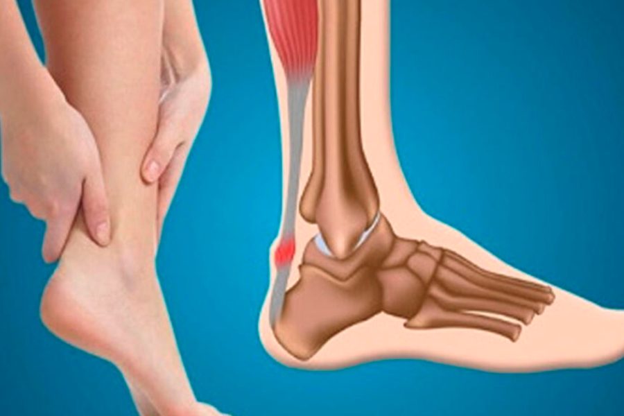 Тендинит ахиллова сухожилия: как вернуть легкость движения без боли