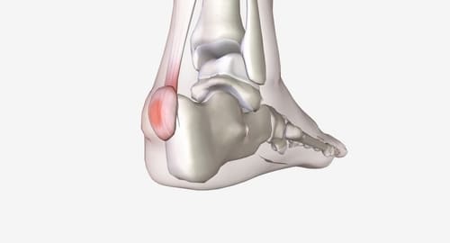 Деформация Хаглунда: как избавиться от боли и шишки на пятке навсегда