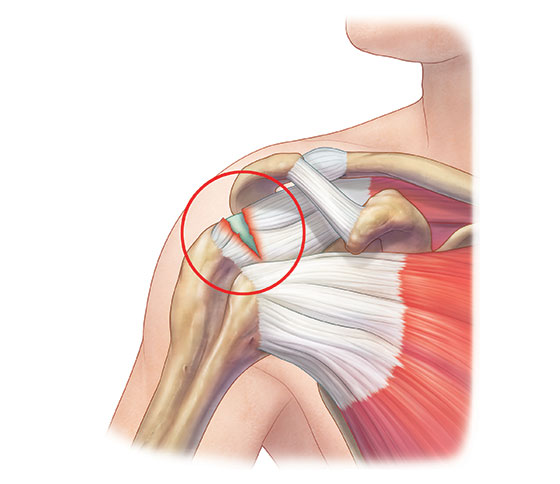 Разрыв вращательной манжеты плеча: обрести подвижность и забыть о боли