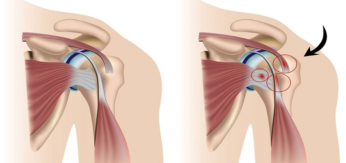 Импинджмент-синдром плеча: от причин и симптомов до полного излечения