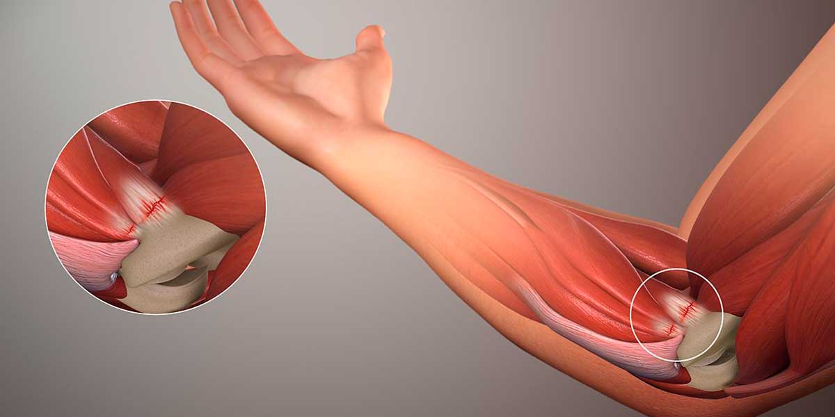 Латеральный эпикондилит: обрести свободу движений и избавиться от боли в локте